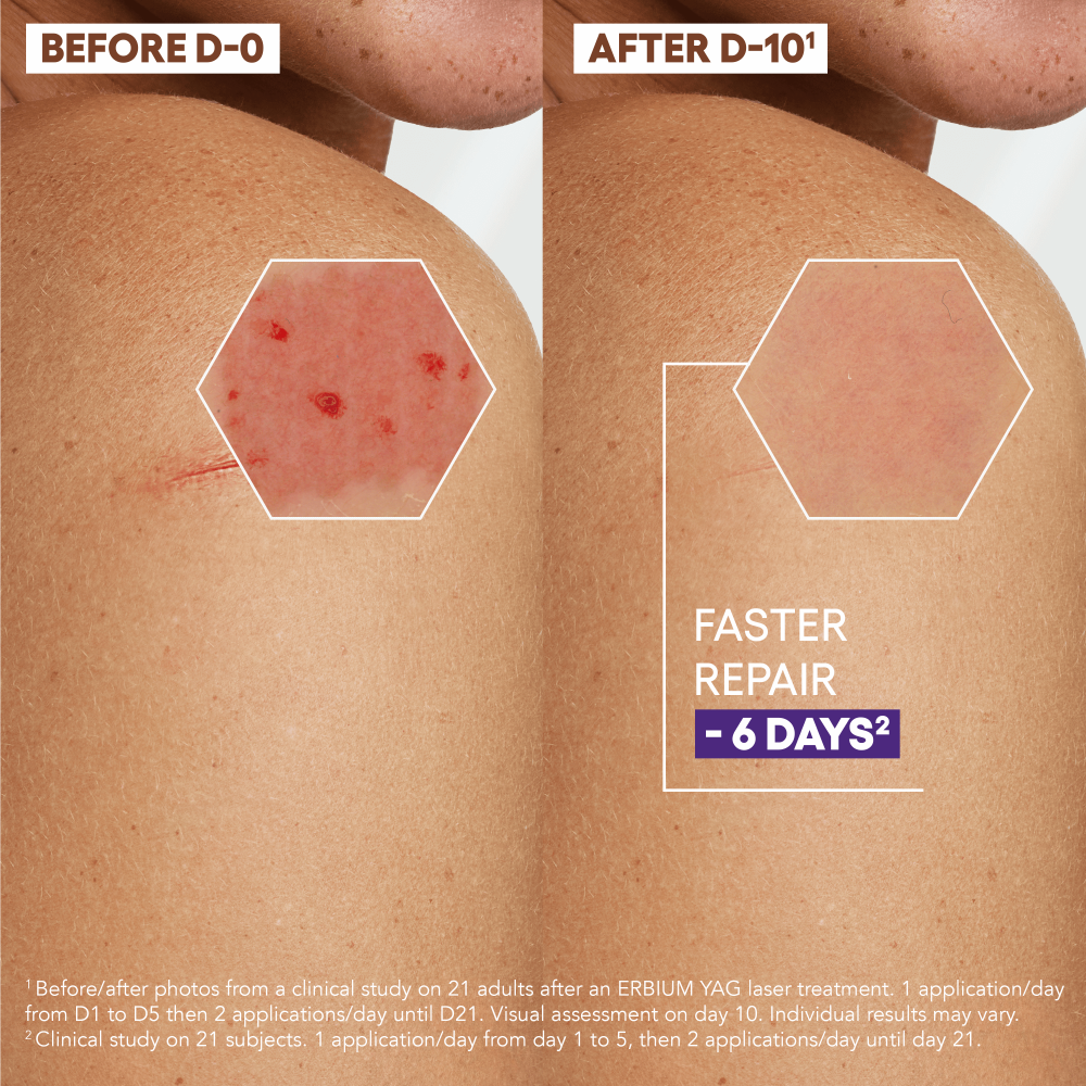 Avant/Après épithéliale crème EN