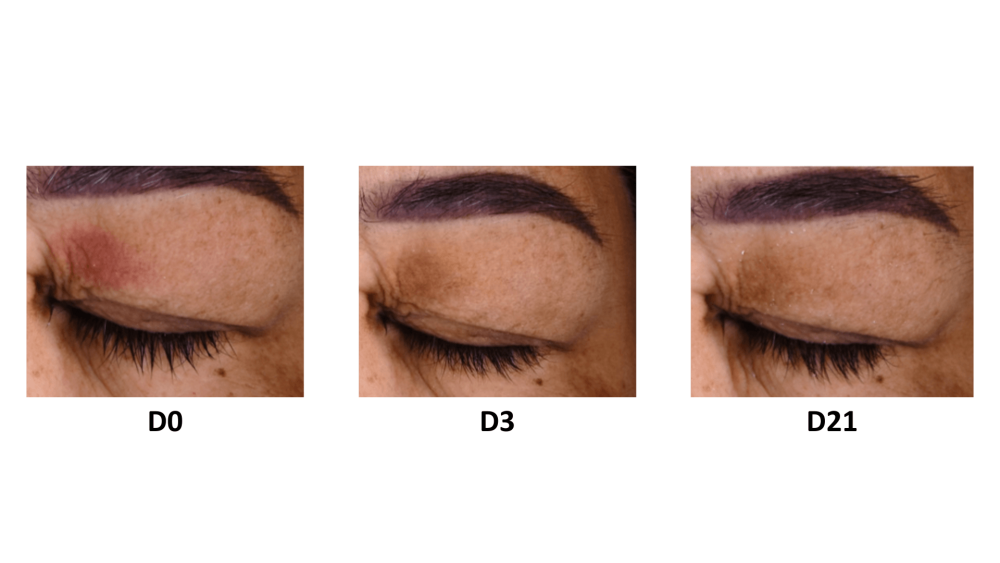 Av Ap palpébral, vers° EN