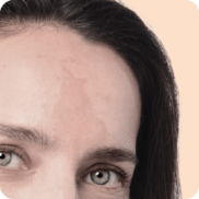 Hyperpigmentation