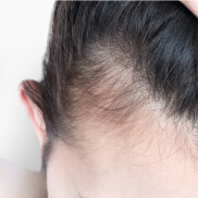 Alopécie réactionnelle