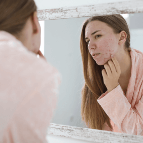 Comment mieux vivre l'acné à l’âge adulte ?
