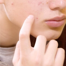 acné légère