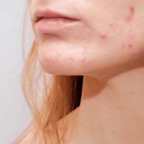 acne