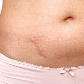 cicatrice ventre large