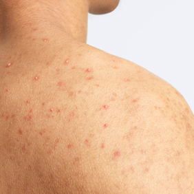 du_keracnyl_body spray_men_pathology_4x5_01.2026