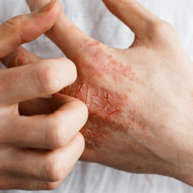 Comment concilier eczéma chronique des mains et vie professionnelle ?