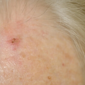 Keratose actinique 3