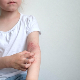 Eczema atopique