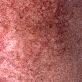 Visuel radiodermite