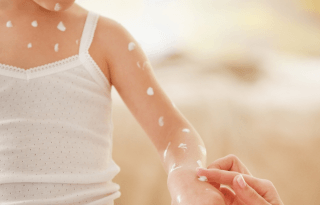 ad_chiken-pox-kids_large_2021.