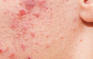 AVENE_ACNE_SEVERE