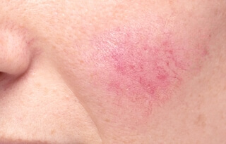 av_peaux-sensibles_acne_rosacee_1x1