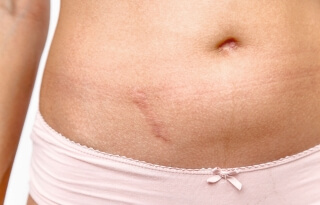 cicatrice ventre large