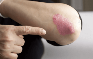 Comment soulager les démangeaisons causées par votre psoriasis en plaque ?