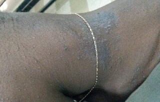 Eczéma-de-contact-01.jpg