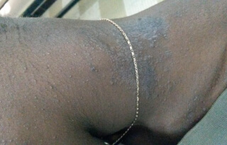 Eczéma-de-contact-01.jpg