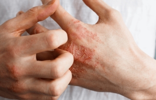 Comment concilier eczéma chronique des mains et vie professionnelle ?