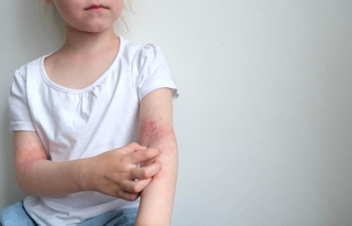 Eczema atopique