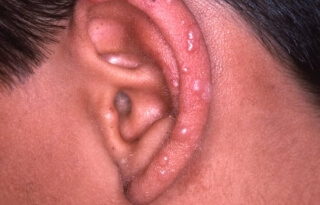 Spring-eruption-of-the-ears-01.jpg