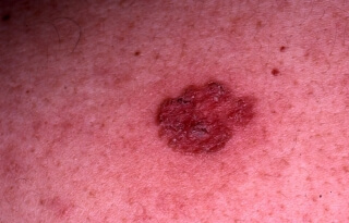 Superficial-basal-cell-carcinoma-BCC-01.jpg