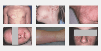 Card Lupus érythémateux systémique
