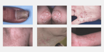 Card Psoriasis