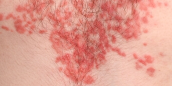 Rash