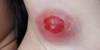 lymphome 2