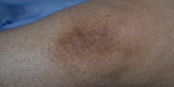 Peau rugueuse 1