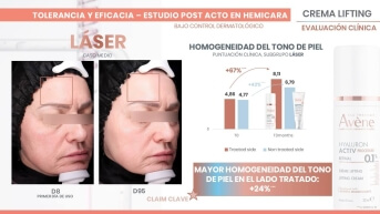 Proven post-laser efficacy