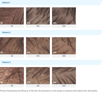 EN-Kelual DS Shampooing · Photos illustratives.png