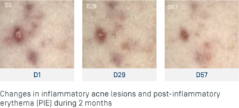 EN-Keracnyl Serum - Evolution lésions.png