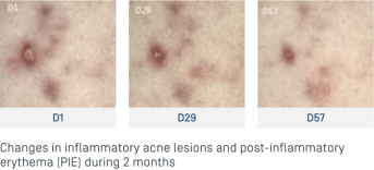 EN-Keracnyl Serum - Evolution lésions.png