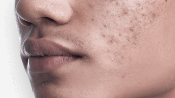 Photo Acné, poster EADV