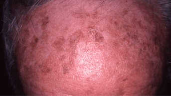 Photo kératose actinique, poster EADV