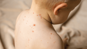 Photo varicelle, poster EADV