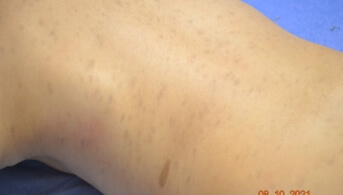 01 Une cause rare d'hyperpigmentation chez l'enfant