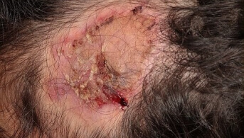 alopecie