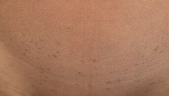 02 Dermatose polymorphe.