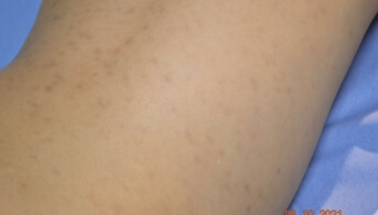 02Une cause rare d'hyperpigmentation chez l'enfant