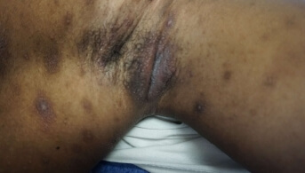 Dermatose pustulair 2