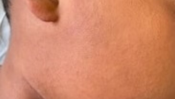 03Infiltration cutanée diffuse