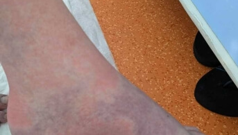 Tricolour dermatosis 2
