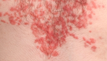 Rash