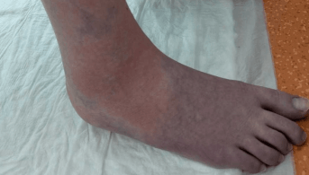 Dermatose tricolore, carrousel