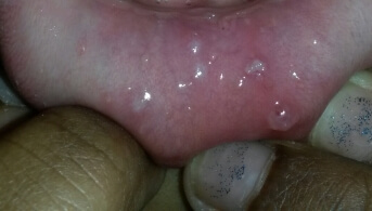 BlisterRed