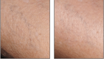 EN-Sensinol Lait · Illustration Xerose.png