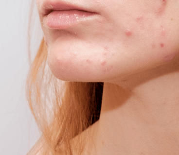 acne