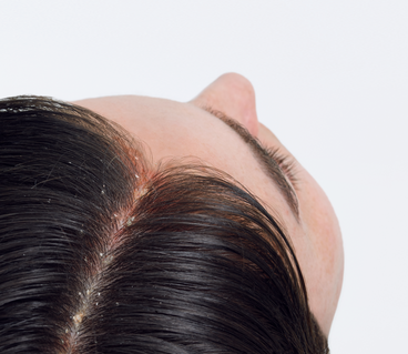 du_kelual ds_sebocontrol_treatment-shampoo_hair_pathology_4x5