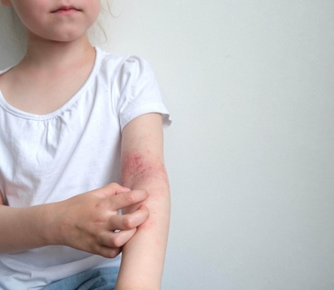 Eczema atopique